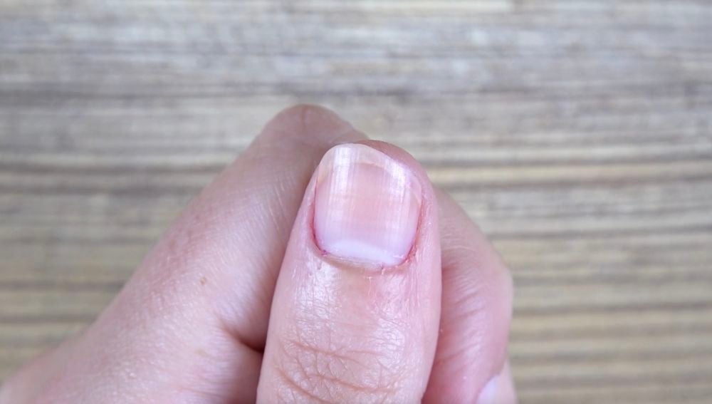 Alergias a las uñas acrílicas Mi experiencia  YouTube